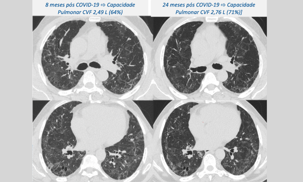 Fapesp: Sequela pulmonar pode piorar dois anos após a internação por covid-19 grave