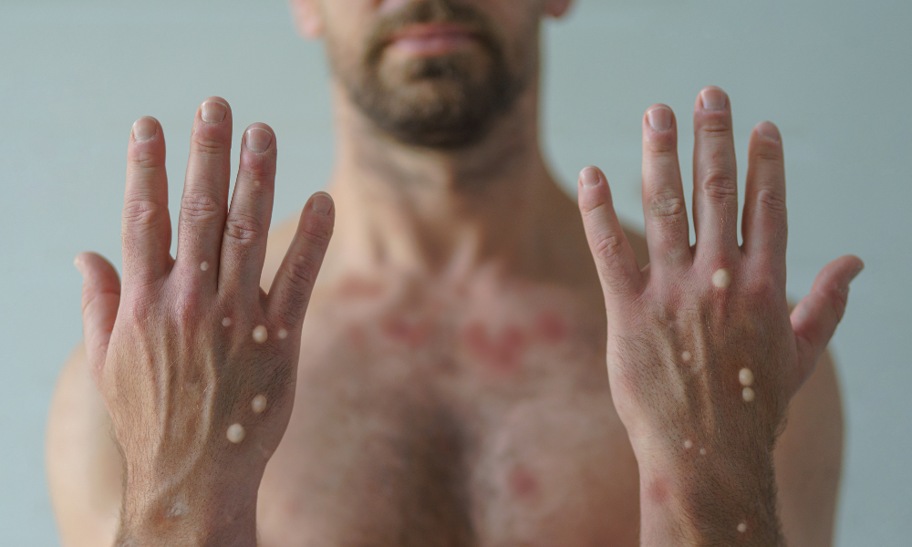 50 perguntas e respostas sobre monkeypox, a mpox